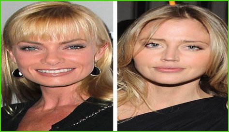 Estella Warren Plastic Surgery Before and After